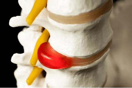 Herniated Disc Surgery: Causes, Treatment, and Outcomes