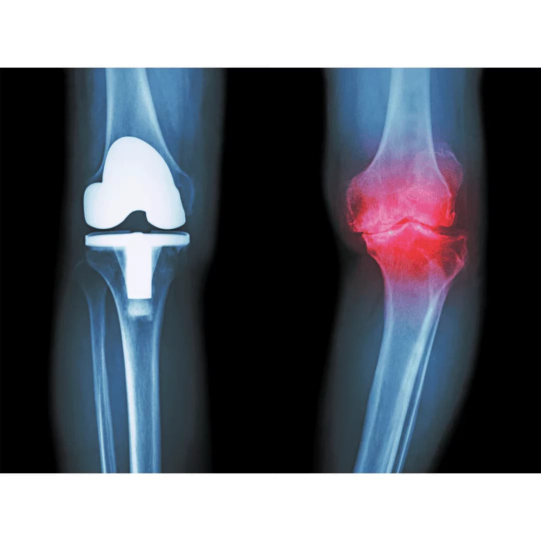 Artificial joint operations