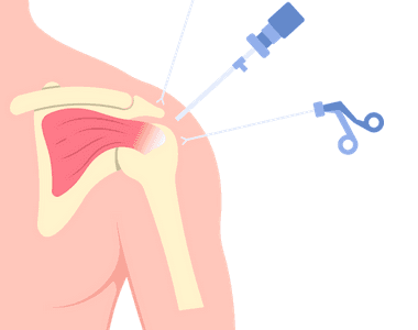 Rotator cuff injury: How to protect yourself from persistent shoulder pain