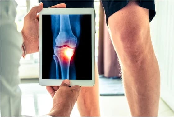 What is degenerative arthritis