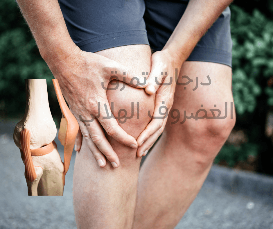 Meniscus tear Stages